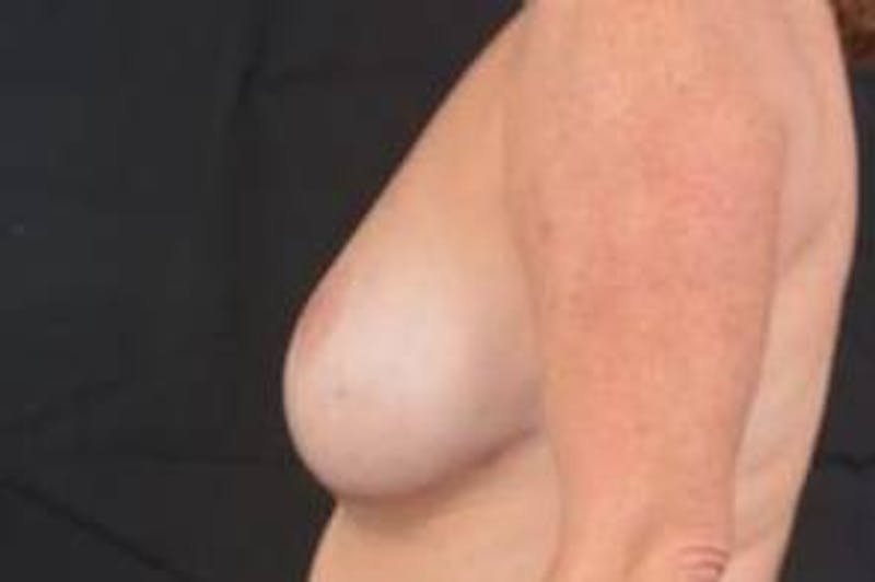 Aesthetic Breast Revision Before & After Gallery - Patient 803318 - Image 3