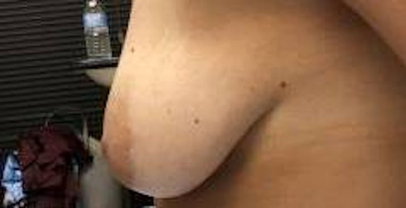 Breast Augmentation Mastopexy Before & After Gallery - Patient 983492 - Image 3