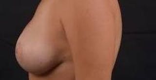 Breast Augmentation Mastopexy Before & After Gallery - Patient 983492 - Image 4