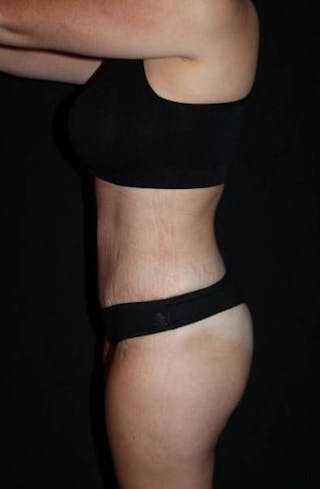 Abdominoplasty Before & After Gallery - Patient 856729 - Image 6