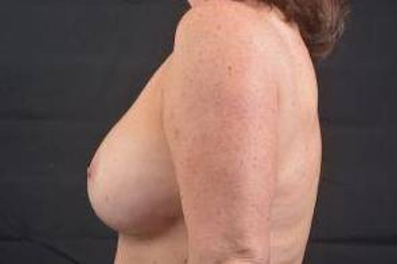 Aesthetic Breast Revision Before & After Gallery - Patient 803318 - Image 4