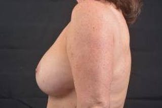 Aesthetic Breast Revision Before & After Gallery - Patient 803318 - Image 4