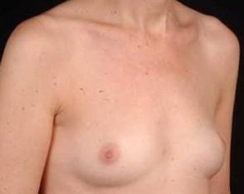 Immediate Breast Reconstruction – Nipple Sparing Before & After Gallery - Patient 275802 - Image 5