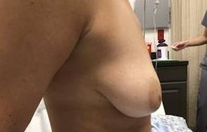 Breast Augmentation Mastopexy Before & After Gallery - Patient 983492 - Image 5