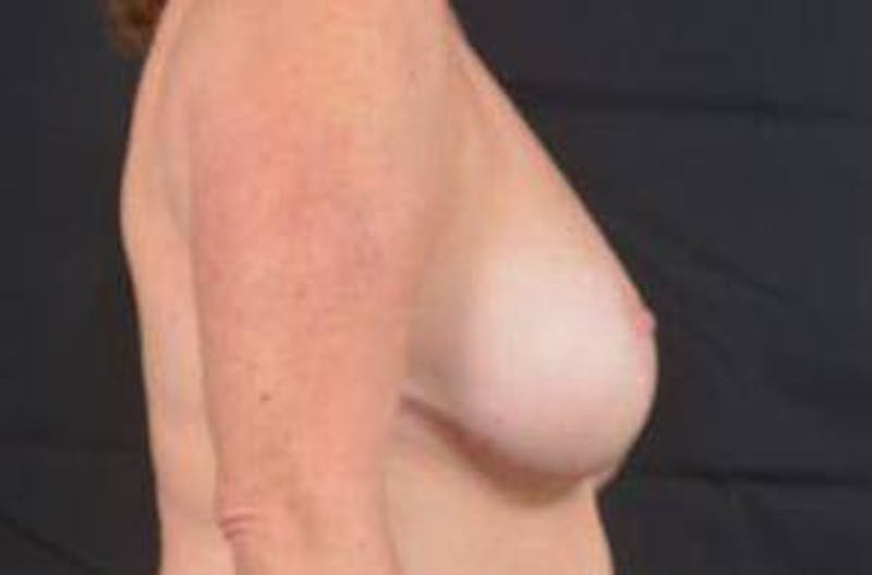 Aesthetic Breast Revision Before & After Gallery - Patient 803318 - Image 5