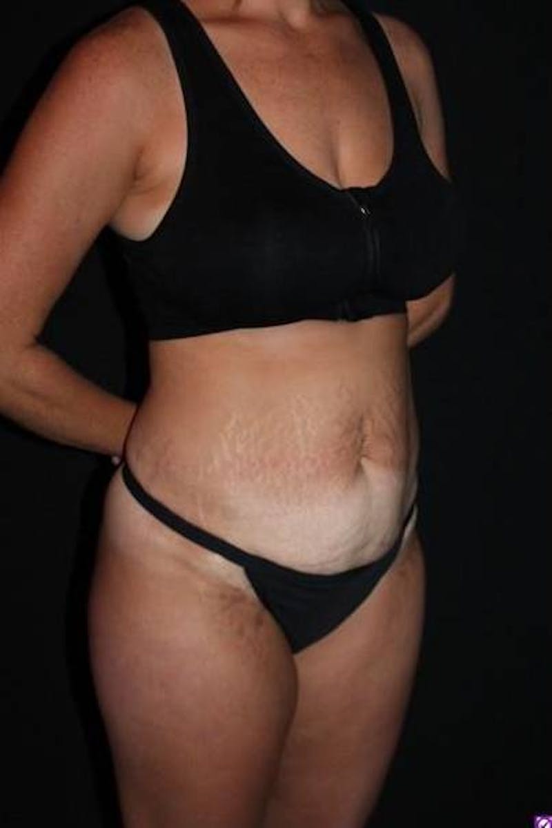 Abdominoplasty Before & After Gallery - Patient 856729 - Image 7