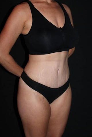 Abdominoplasty Before & After Gallery - Patient 856729 - Image 8