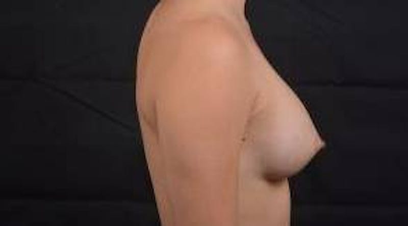 Breast Augmentation Silicone Gel Before & After Gallery - Patient 175424 - Image 6