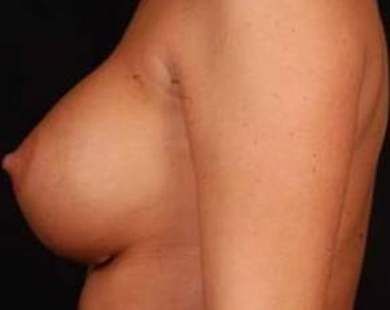 Immediate Breast Reconstruction – Nipple Sparing Before & After Gallery - Patient 267235 - Image 3