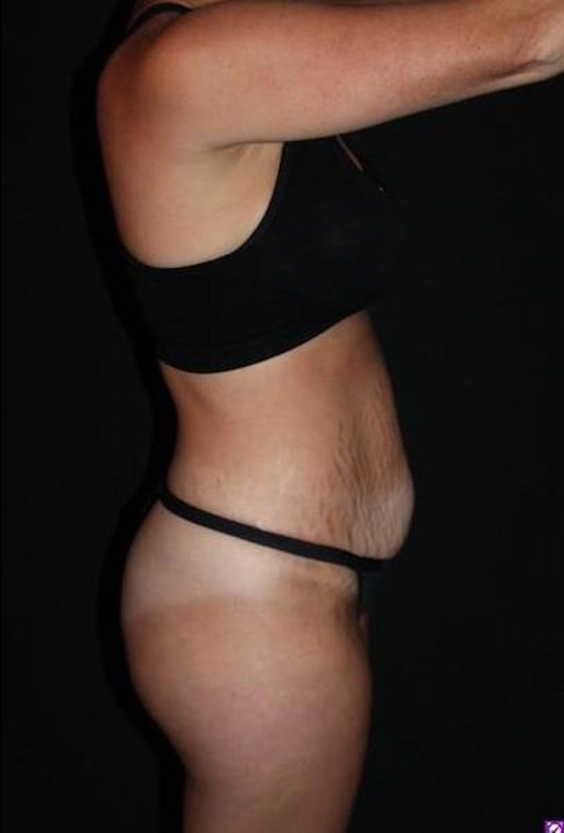 Abdominoplasty Before & After Gallery - Patient 856729 - Image 9