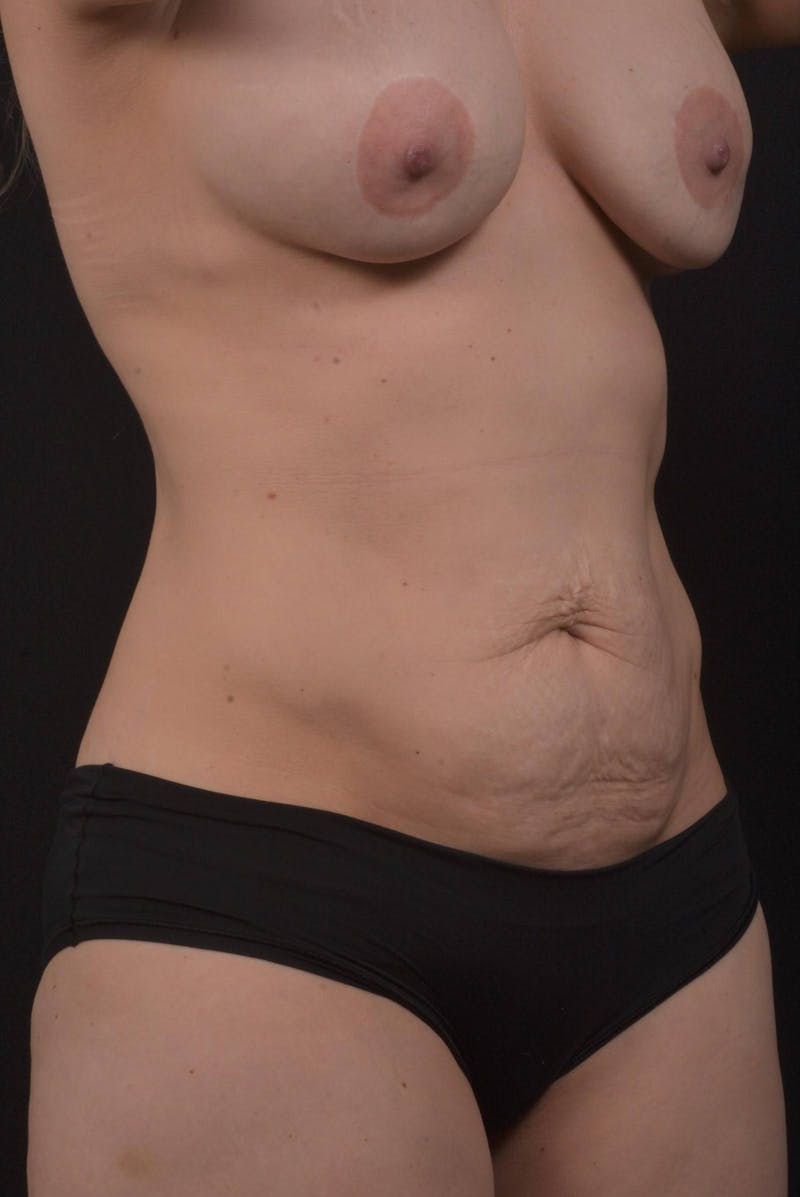 Mommy Makeover Before & After Gallery - Patient 314130 - Image 7