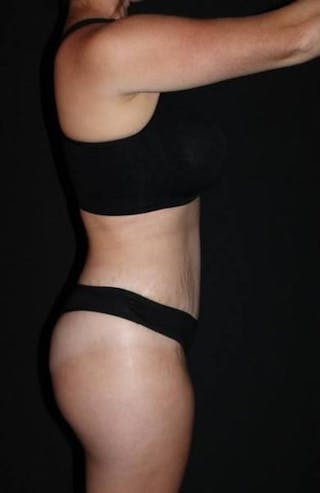Abdominoplasty Before & After Gallery - Patient 856729 - Image 10