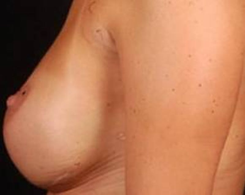 Immediate Breast Reconstruction – Nipple Sparing Before & After Gallery - Patient 267235 - Image 4