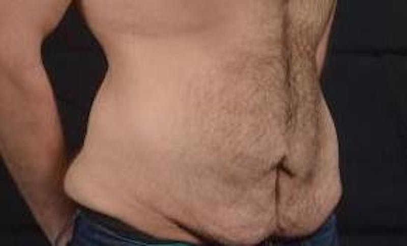 Abdominoplasty Before & After Gallery - Patient 367208 - Image 3