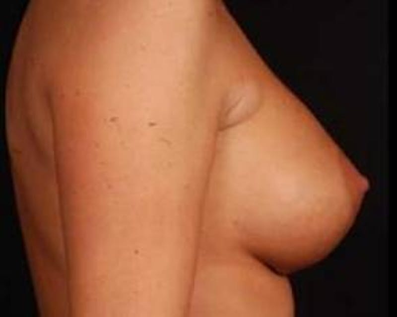 Immediate Breast Reconstruction – Nipple Sparing Before & After Gallery - Patient 267235 - Image 5