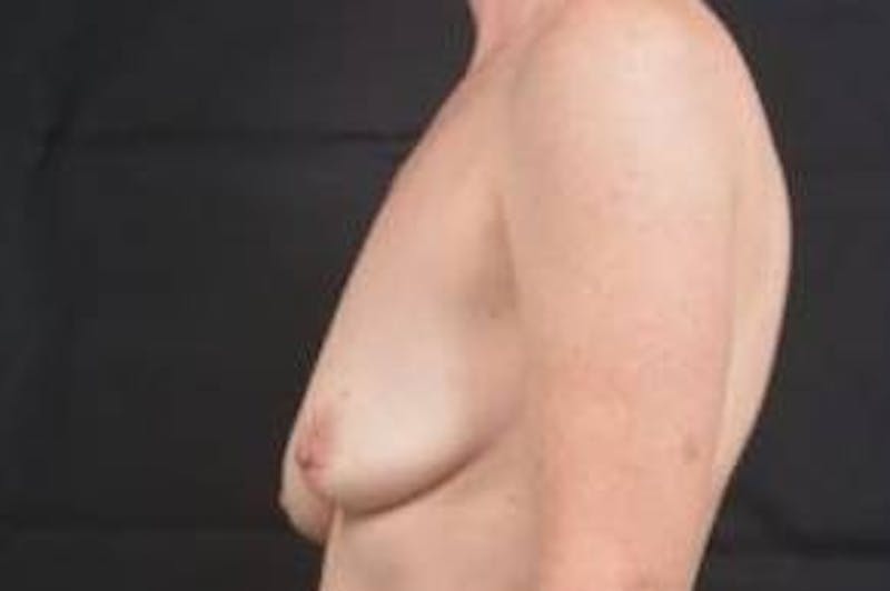 Breast Augmentation Mastopexy Before & After Gallery - Patient 246646 - Image 3