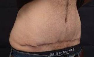 Abdominoplasty Before & After Gallery - Patient 367208 - Image 4