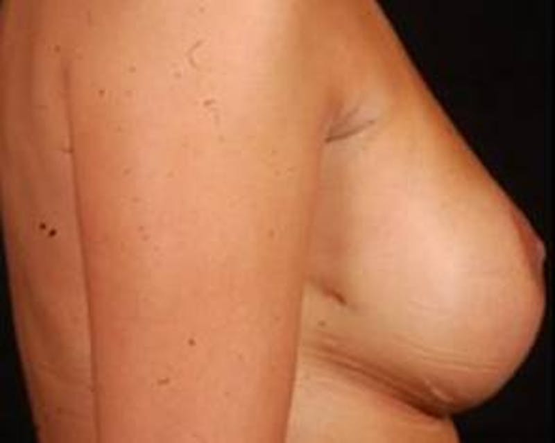 Immediate Breast Reconstruction – Nipple Sparing Before & After Gallery - Patient 267235 - Image 6