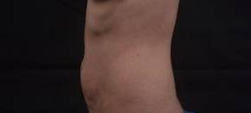 Abdominoplasty Before & After Gallery - Patient 127737 - Image 3