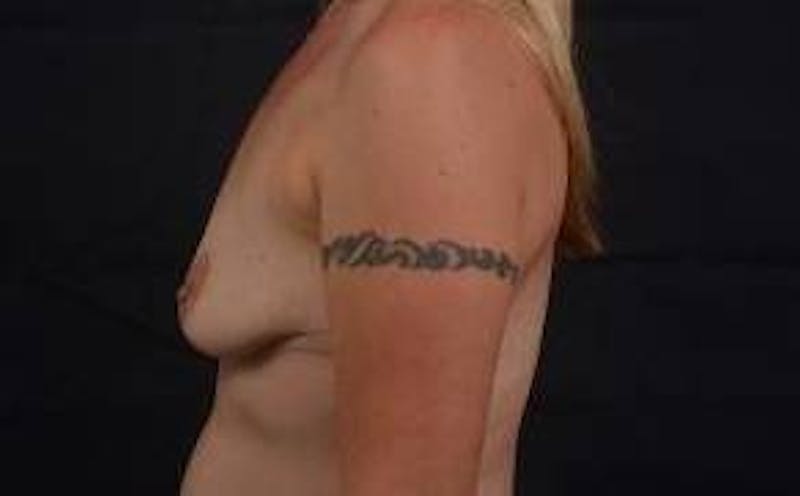 Breast Augmentation Silicone Gel Before & After Gallery - Patient 745021 - Image 3