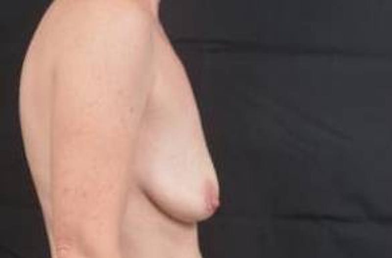 Breast Augmentation Mastopexy Before & After Gallery - Patient 246646 - Image 5