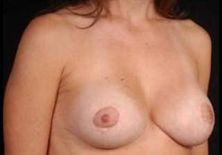 Aesthetic Breast Revision Before & After Gallery - Patient 426259 - Image 6