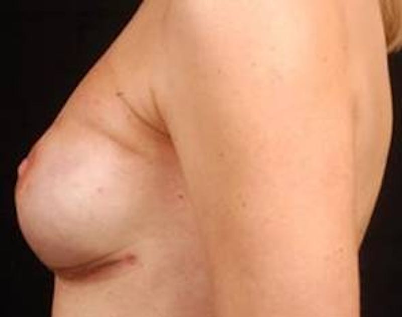 Immediate Breast Reconstruction – Nipple Sparing Before & After Gallery - Patient 126842 - Image 4