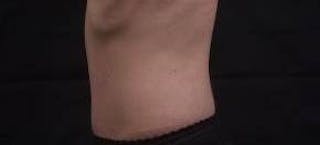 Abdominoplasty Before & After Gallery - Patient 127737 - Image 4