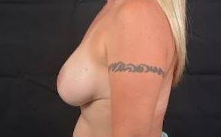 Breast Augmentation Silicone Gel Before & After Gallery - Patient 745021 - Image 4