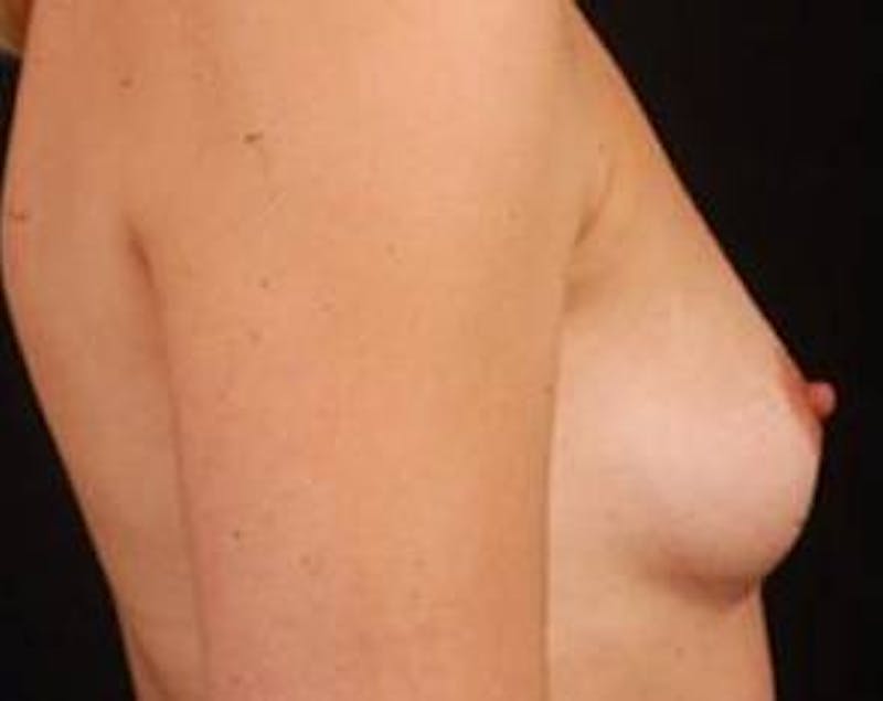 Immediate Breast Reconstruction – Nipple Sparing Before & After Gallery - Patient 126842 - Image 5