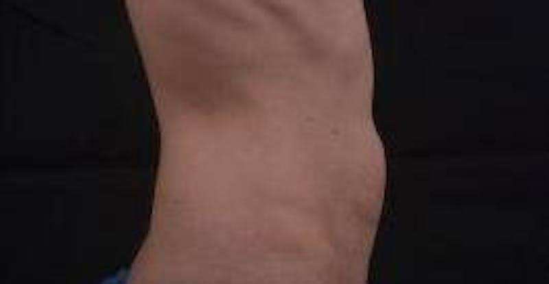 Abdominoplasty Before & After Gallery - Patient 127737 - Image 5