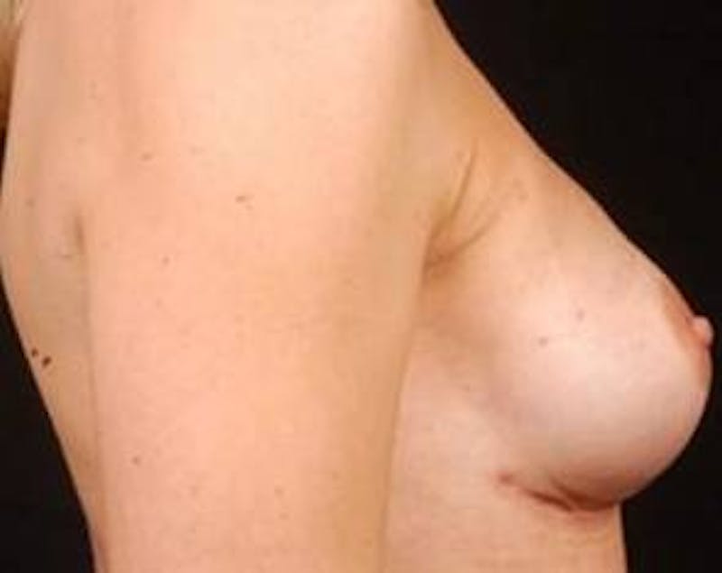 Immediate Breast Reconstruction – Nipple Sparing Before & After Gallery - Patient 126842 - Image 6