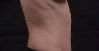 Abdominoplasty Before & After Gallery - Patient 127737 - Image 6