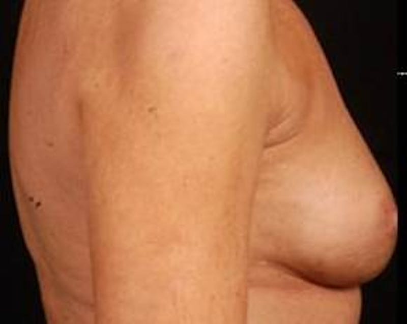 Immediate Breast Reconstruction – Nipple Sparing Before & After Gallery - Patient 143436 - Image 3