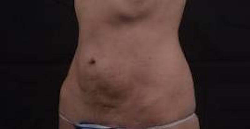 Abdominoplasty Before & After Gallery - Patient 127737 - Image 7