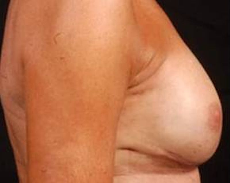 Immediate Breast Reconstruction – Nipple Sparing Before & After Gallery - Patient 143436 - Image 4