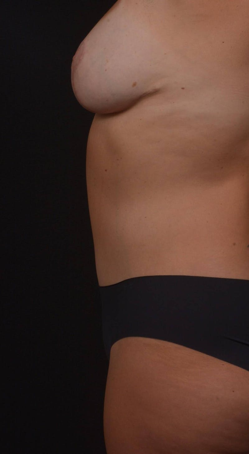 Mommy Makeover Before & After Gallery - Patient 130274 - Image 6