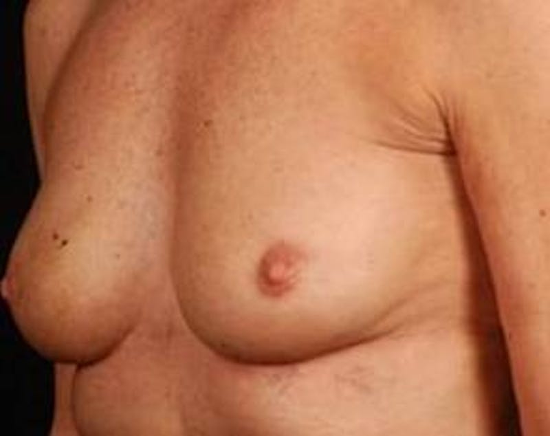 Immediate Breast Reconstruction – Nipple Sparing Before & After Gallery - Patient 143436 - Image 5