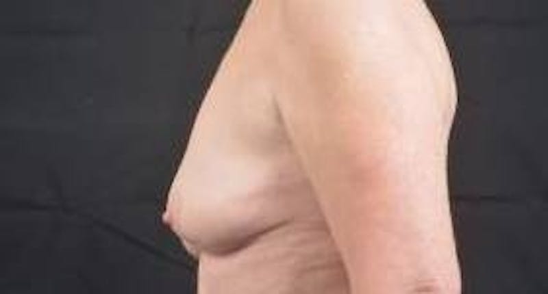Breast Augmentation Mastopexy Before & After Gallery - Patient 759950 - Image 3