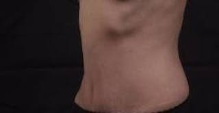 Abdominoplasty Before & After Gallery - Patient 127737 - Image 8