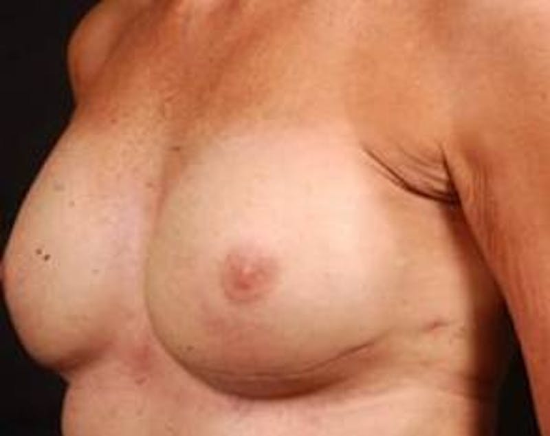 Immediate Breast Reconstruction – Nipple Sparing Before & After Gallery - Patient 143436 - Image 6