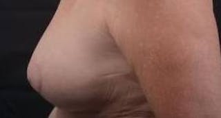 Breast Augmentation Mastopexy Before & After Gallery - Patient 759950 - Image 4