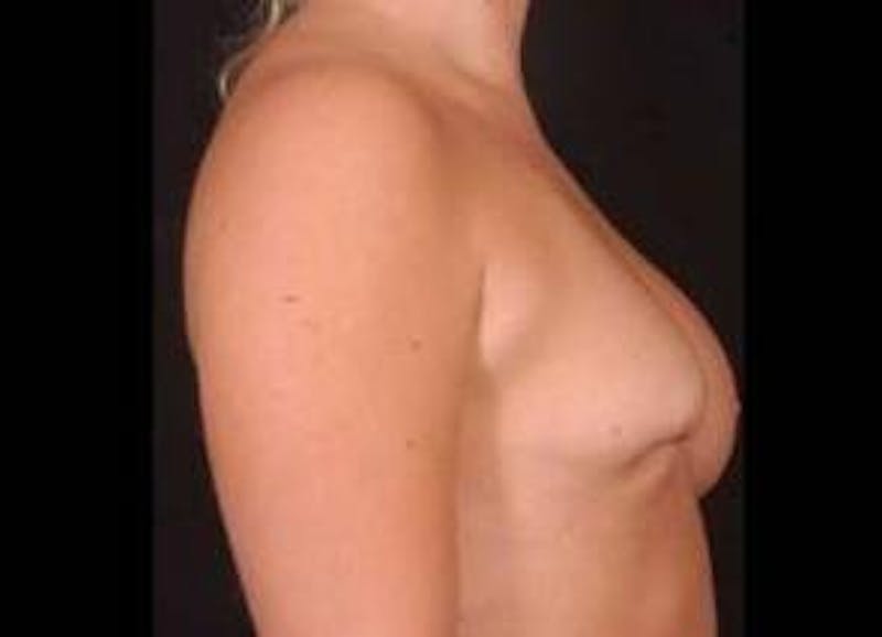 Aesthetic Breast Revision Before & After Gallery - Patient 105619 - Image 3