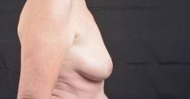 Breast Augmentation Mastopexy Before & After Gallery - Patient 759950 - Image 5