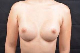 Breast Augmentation Silicone Gel Before & After Gallery - Patient 408071 - Image 2