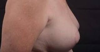 Breast Augmentation Mastopexy Before & After Gallery - Patient 759950 - Image 6