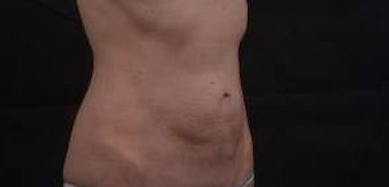 Abdominoplasty Before & After Gallery - Patient 127737 - Image 9