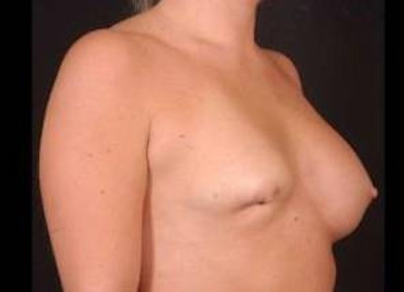 Aesthetic Breast Revision Before & After Gallery - Patient 105619 - Image 5