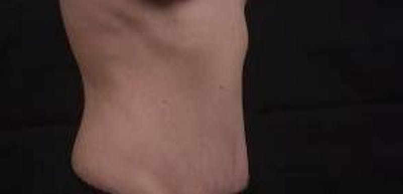 Abdominoplasty Before & After Gallery - Patient 127737 - Image 10
