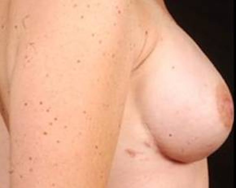 Immediate Breast Reconstruction – Nipple Sparing Before & After Gallery - Patient 420678 - Image 4